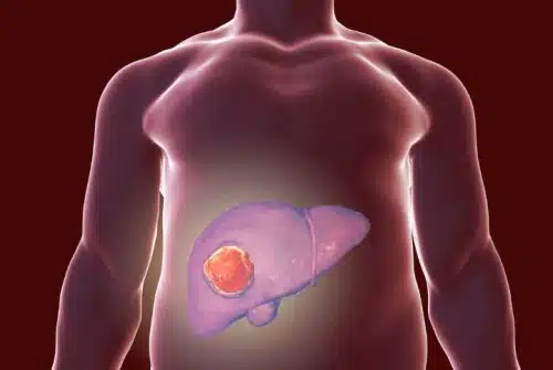 Les facteurs de risques du cancer du foie