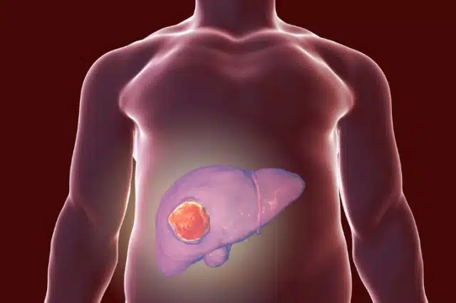 Les facteurs de risques du cancer du foie